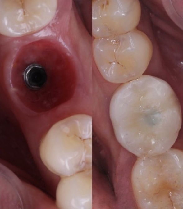 IMPLANTES DENTALES